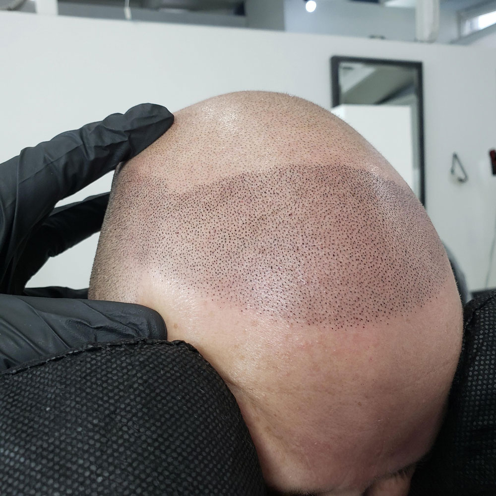 Close-up of scalp micropigmentation detail at Rebel Aesthetics New Jersey.
