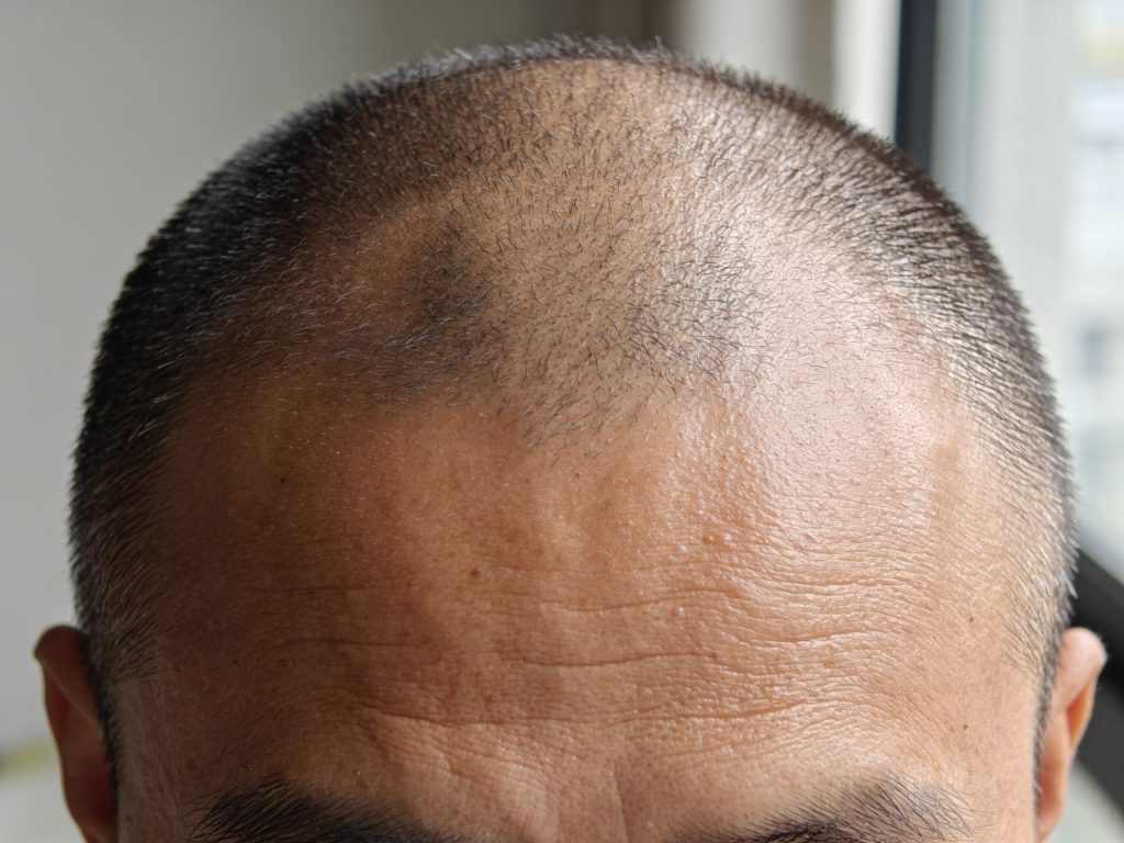 5 SMP aftercare rules that protect your shaved-head results